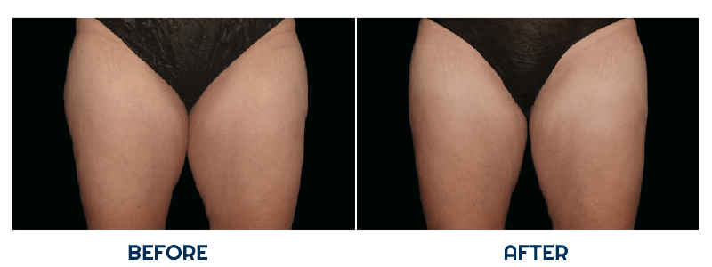 fatty_legs-1-min