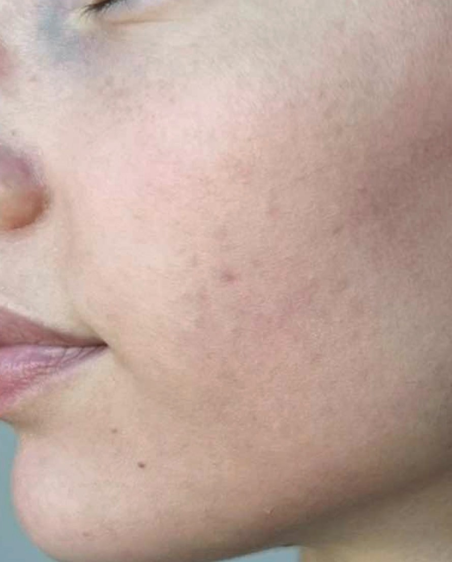 After SkinPen microneedling: smoother cheek with improved acne scarring
