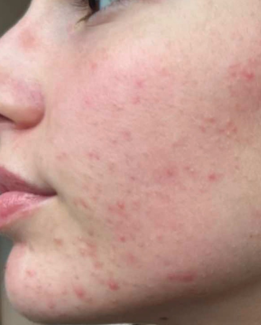 Before SkinPen microneedling: cheek with acne and acne scarring