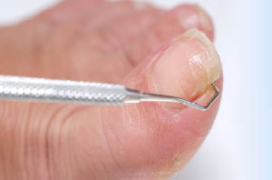 toenail fungus treatment options